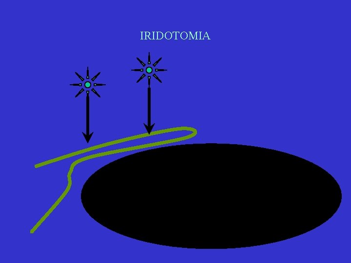 IRIDOTOMIA IRIDOTOMIA