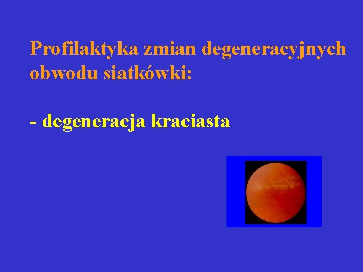 Profilaktyka zmian degeneracyjnych obwodu siatkówki: - degeneracja kraciasta Profilaktyka zmian degeneracyjnych obwodu siatkówki: - degeneracja kraciasta