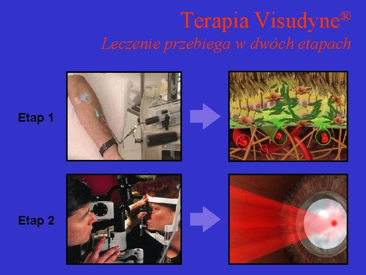 Terapia Visudyne® Leczenie przebiega w dwóch etapach Etap 1 Etap 2 Terapia Visudyne® Leczenie przebiega w dwóch etapach Etap 1 Etap 2