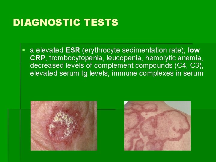 DIAGNOSTIC TESTS § a elevated ESR (erythrocyte sedimentation rate), low CRP, trombocytopenia, leucopenia, hemolytic