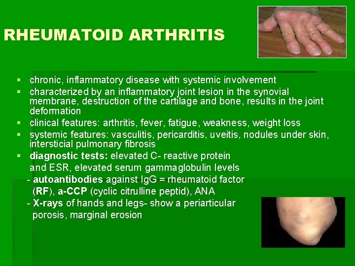RHEUMATOID ARTHRITIS § chronic, inflammatory disease with systemic involvement § characterized by an inflammatory