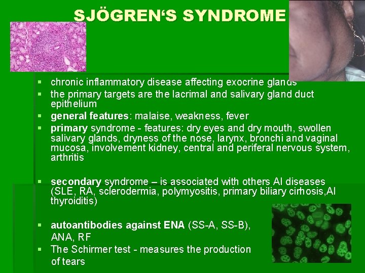 SJÖGREN‘S SYNDROME § chronic inflammatory disease affecting exocrine glands § the primary targets are