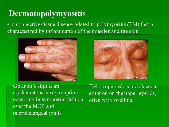 Dermatopolymyositis • a connective-tissue disease related to polymyositis (PM) that is characterized by inflammation
