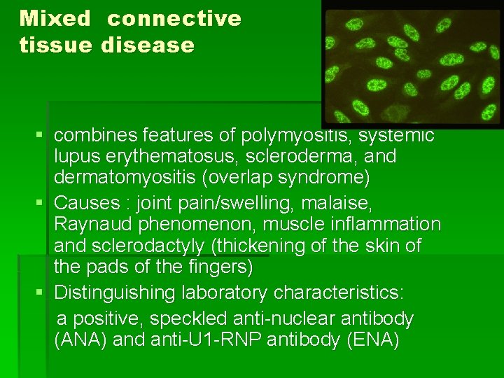 Mixed connective tissue disease § combines features of polymyositis, systemic lupus erythematosus, scleroderma, and