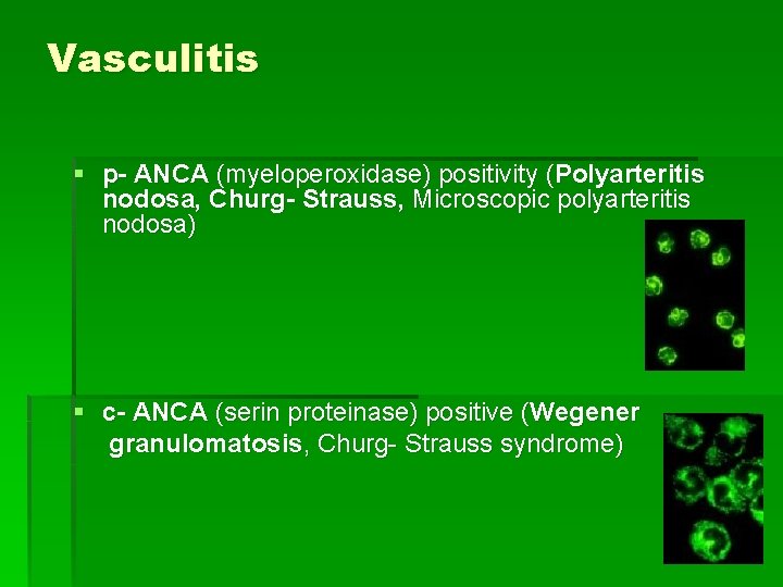 Vasculitis § p- ANCA (myeloperoxidase) positivity (Polyarteritis nodosa, Churg- Strauss, Microscopic polyarteritis nodosa) §