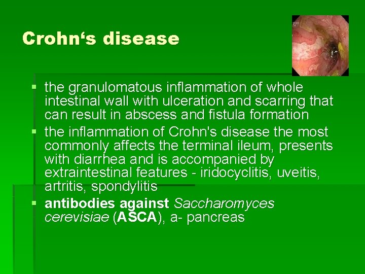 Crohn‘s disease § the granulomatous inflammation of whole intestinal wall with ulceration and scarring