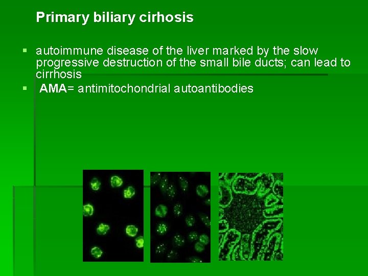 Primary biliary cirhosis § autoimmune disease of the liver marked by the slow progressive