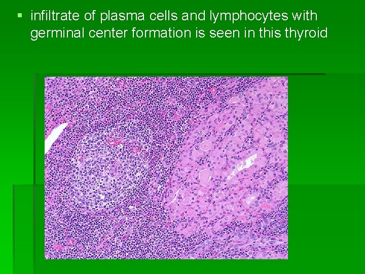 § infiltrate of plasma cells and lymphocytes with germinal center formation is seen in