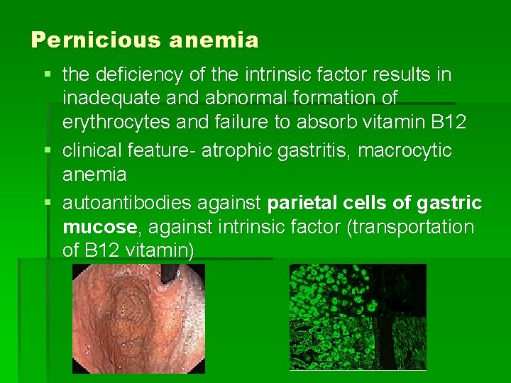 Pernicious anemia § the deficiency of the intrinsic factor results in inadequate and abnormal