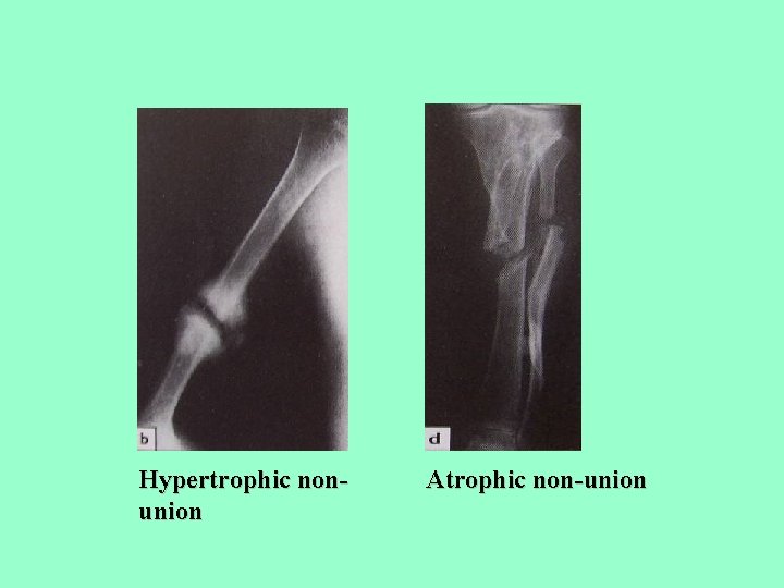 Hypertrophic nonunion Atrophic non-union 