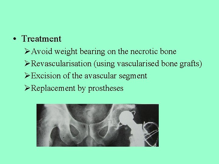  • Treatment ØAvoid weight bearing on the necrotic bone ØRevascularisation (using vascularised bone