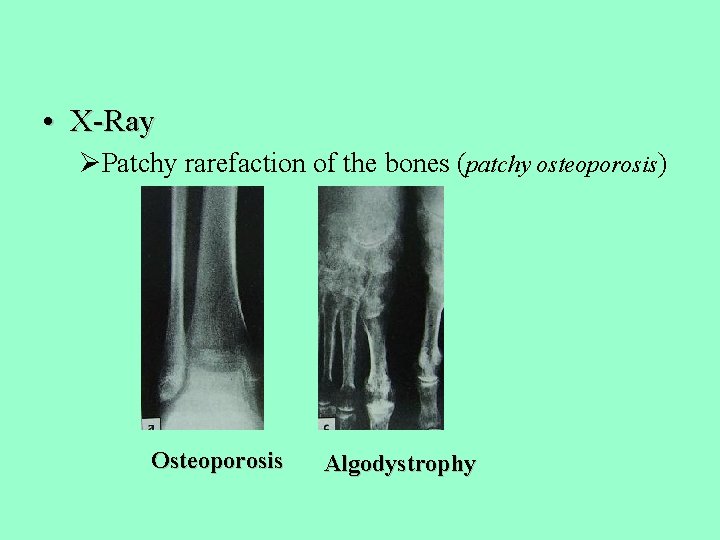  • X-Ray ØPatchy rarefaction of the bones (patchy osteoporosis) Osteoporosis Algodystrophy 