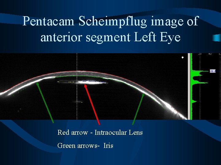 Pentacam Scheimpflug image of anterior segment Left Eye Red arrow - Intraocular Lens Green