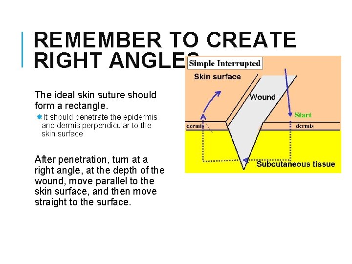 REMEMBER TO CREATE RIGHT ANGLES The ideal skin suture should form a rectangle. It REMEMBER TO CREATE RIGHT ANGLES The ideal skin suture should form a rectangle. It