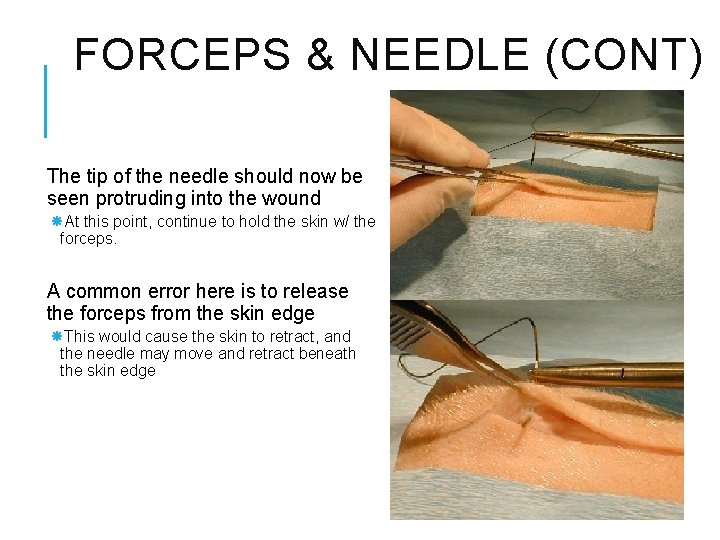 FORCEPS & NEEDLE (CONT) The tip of the needle should now be seen protruding FORCEPS & NEEDLE (CONT) The tip of the needle should now be seen protruding