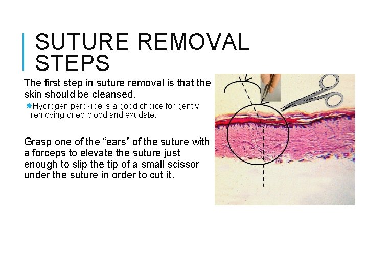 SUTURE REMOVAL STEPS The first step in suture removal is that the skin should SUTURE REMOVAL STEPS The first step in suture removal is that the skin should