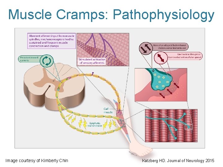 Muscle Cramps: Pathophysiology Image courtesy of Kimberly Chin Katzberg HD. Journal of Neurology 2015