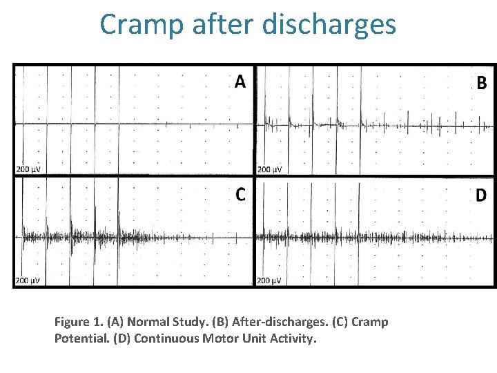 Cramp after discharges Figure 1. (A) Normal Study. (B) After-discharges. (C) Cramp Potential. (D)