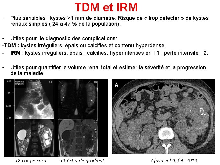 TDM et IRM • Plus sensibles : kystes >1 mm de diamètre. Risque de