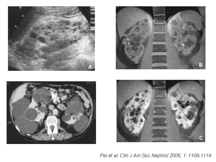 Pei et al. Clin J Am Soc Nephrol 2006; 1: 1108 -1114 