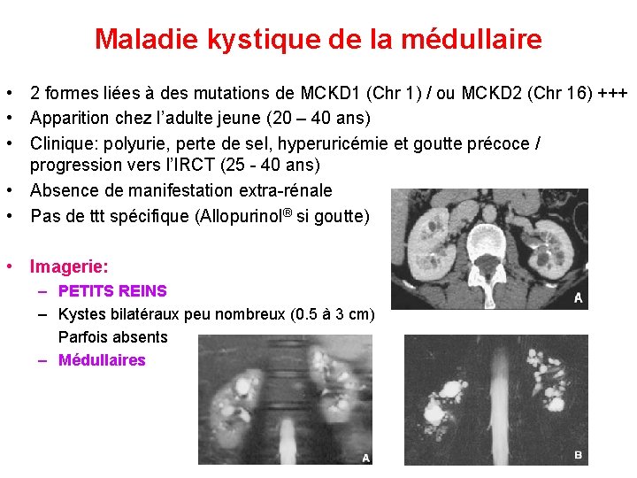 Maladie kystique de la médullaire • 2 formes liées à des mutations de MCKD