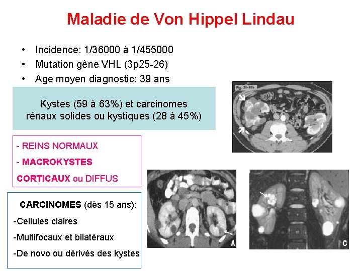 Maladie de Von Hippel Lindau • Incidence: 1/36000 à 1/455000 • Mutation gène VHL