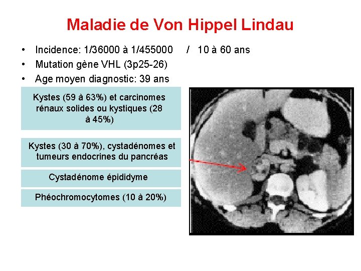 Maladie de Von Hippel Lindau • Incidence: 1/36000 à 1/455000 / 10 à 60
