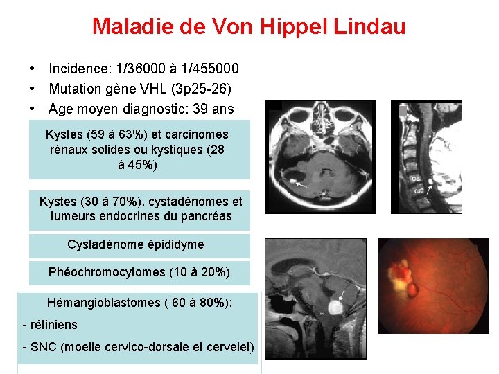 Maladie de Von Hippel Lindau • Incidence: 1/36000 à 1/455000 • Mutation gène VHL