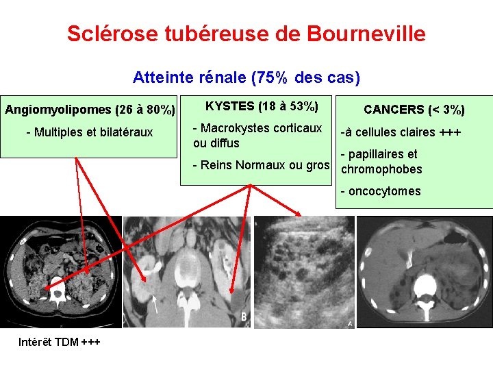 Sclérose tubéreuse de Bourneville Atteinte rénale (75% des cas) Angiomyolipomes (26 à 80%) KYSTES