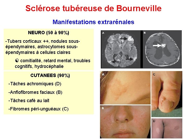 Sclérose tubéreuse de Bourneville Manifestations extrarénales NEURO (50 à 90%) -Tubers corticaux ++, nodules