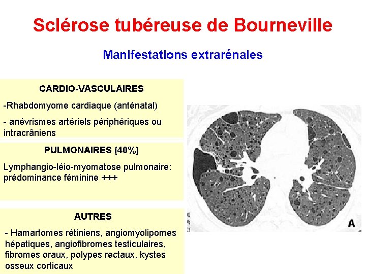 Sclérose tubéreuse de Bourneville Manifestations extrarénales CARDIO-VASCULAIRES -Rhabdomyome cardiaque (anténatal) - anévrismes artériels périphériques