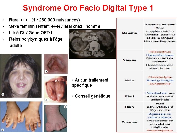 Syndrome Oro Facio Digital Type 1 • Rare ++++ (1 / 250 000 naissances)