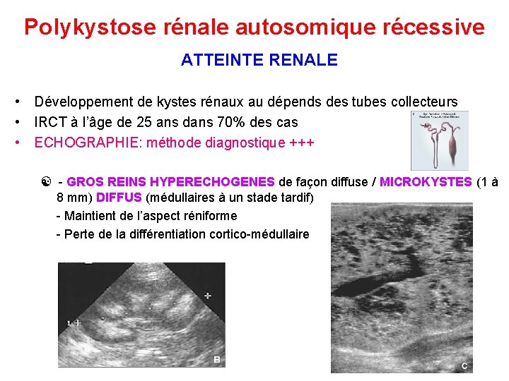 Polykystose rénale autosomique récessive ATTEINTE RENALE • Développement de kystes rénaux au dépends des