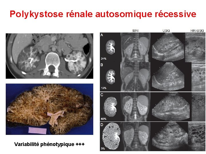 Polykystose rénale autosomique récessive Variabilité phénotypique +++ 