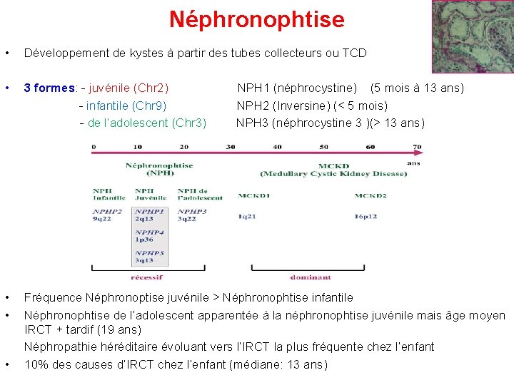Néphronophtise • Développement de kystes à partir des tubes collecteurs ou TCD • 3