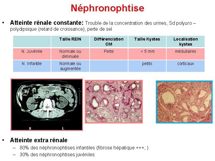 Néphronophtise • Atteinte rénale constante: Trouble de la concentration des urines, Sd polyuro –
