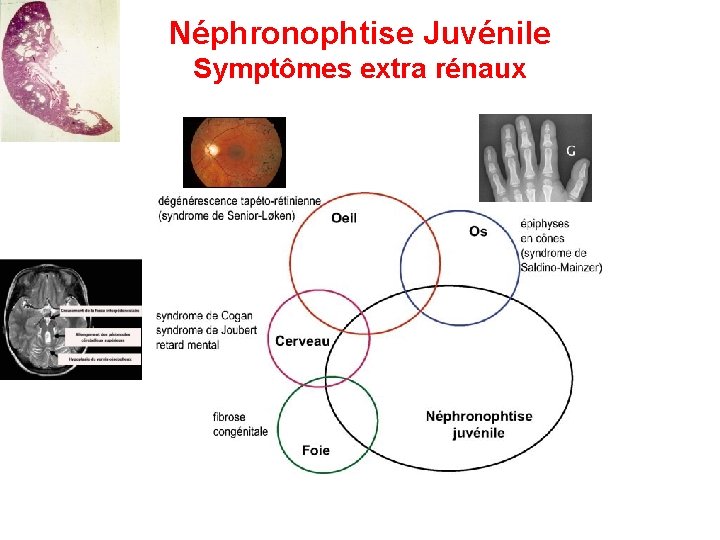 Néphronophtise Juvénile Symptômes extra rénaux 