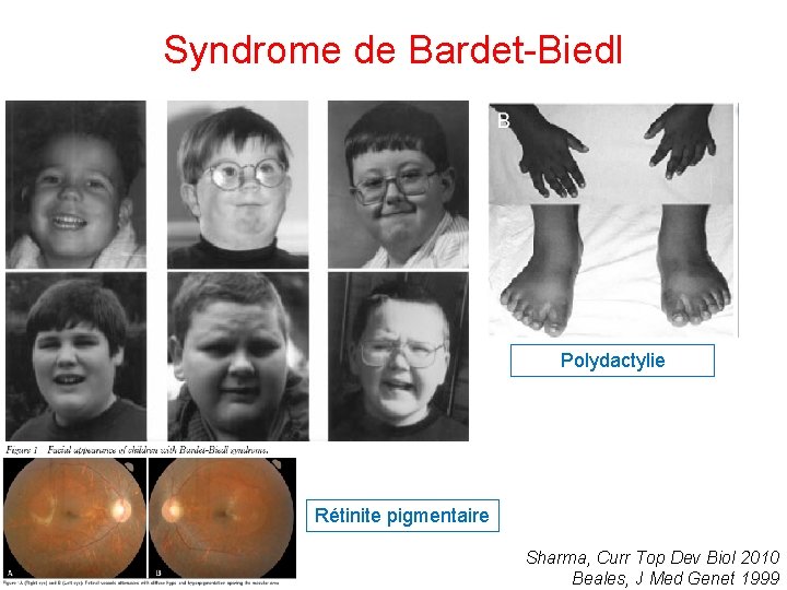 Syndrome de Bardet-Biedl Polydactylie Rétinite pigmentaire Sharma, Curr Top Dev Biol 2010 Beales, J