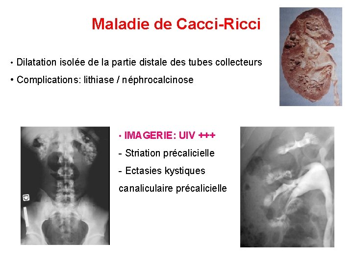 Maladie de Cacci-Ricci • Dilatation isolée de la partie distale des tubes collecteurs •