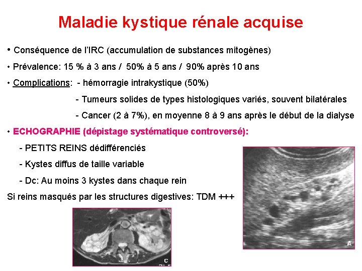 Maladie kystique rénale acquise • Conséquence de l’IRC (accumulation de substances mitogènes) • Prévalence: