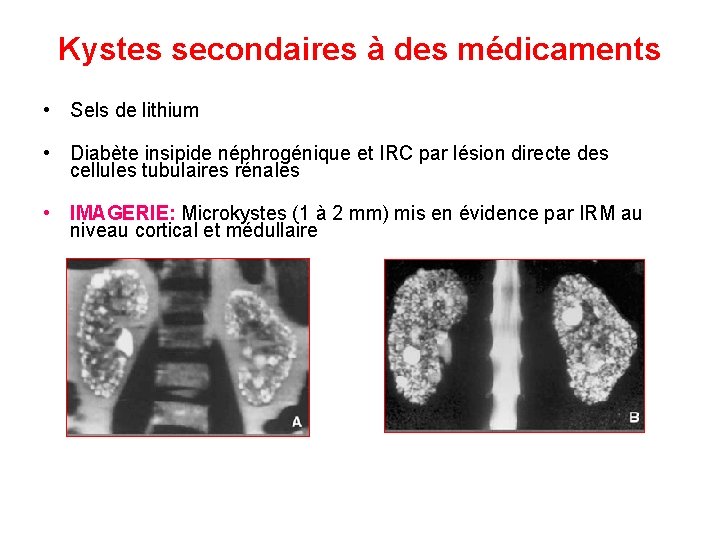 Kystes secondaires à des médicaments • Sels de lithium • Diabète insipide néphrogénique et