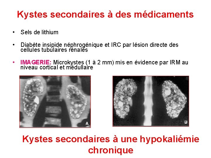 Kystes secondaires à des médicaments • Sels de lithium • Diabète insipide néphrogénique et