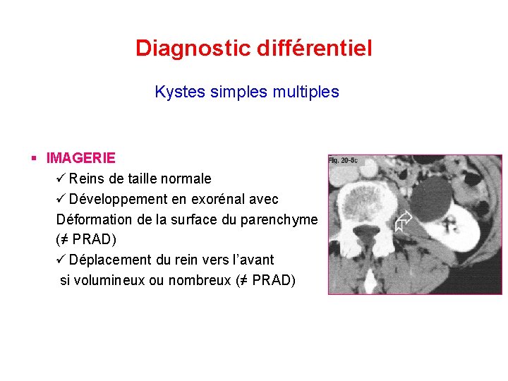Diagnostic différentiel Kystes simples multiples § IMAGERIE ü Reins de taille normale ü Développement