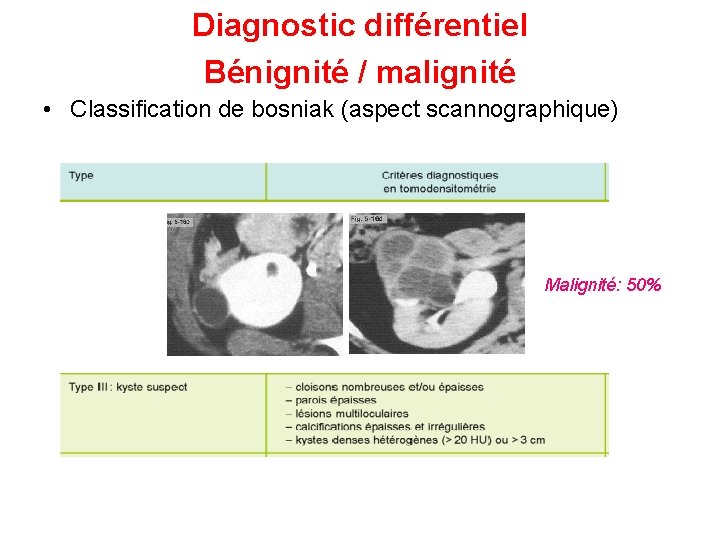 Diagnostic différentiel Bénignité / malignité • Classification de bosniak (aspect scannographique) Malignité: 50% 