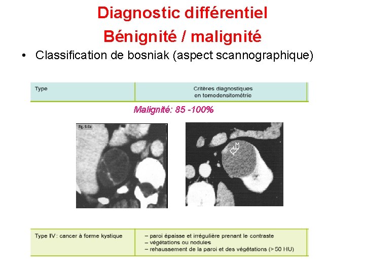 Diagnostic différentiel Bénignité / malignité • Classification de bosniak (aspect scannographique) Malignité: 85 -100%