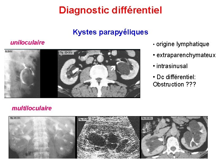 Diagnostic différentiel Kystes parapyéliques uniloculaire • origine lymphatique • extraparenchymateux • intrasinusal • Dc