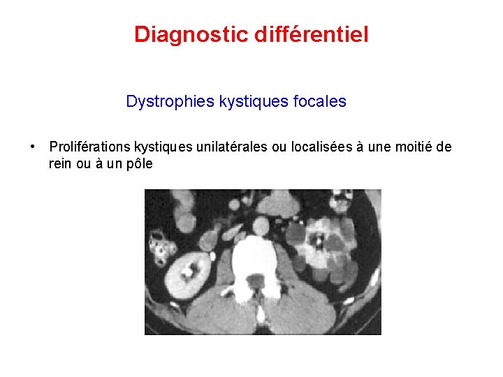 Diagnostic différentiel Dystrophies kystiques focales • Proliférations kystiques unilatérales ou localisées à une moitié