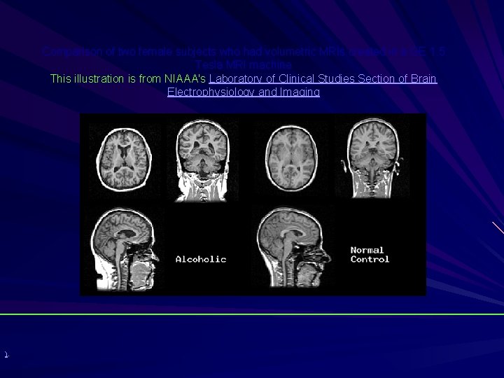 Comparison of two female subjects who had volumetric MRIs created in a GE 1.