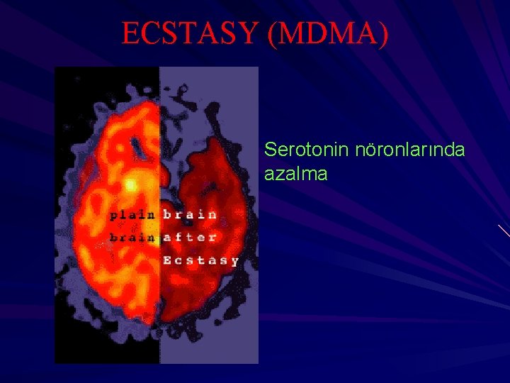 ECSTASY (MDMA) Serotonin nöronlarında azalma 