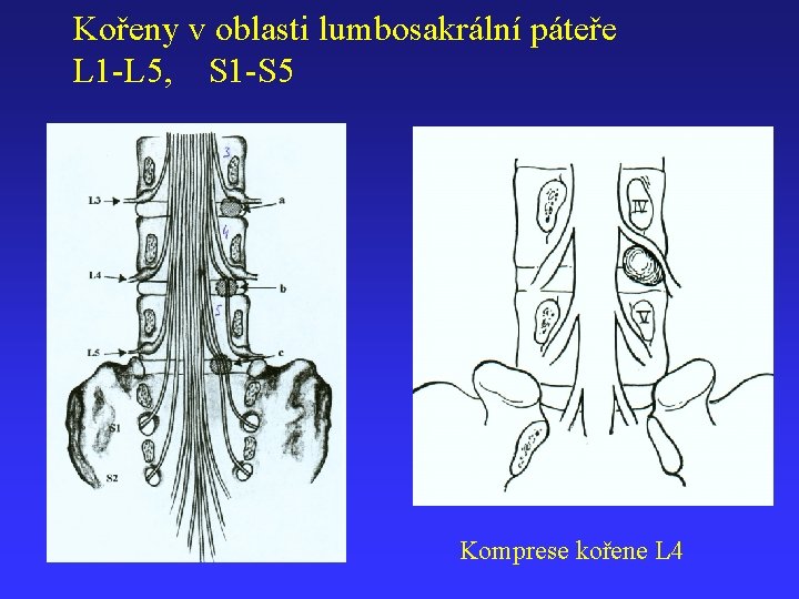 Kořeny v oblasti lumbosakrální páteře L 1 -L 5, S 1 -S 5 Komprese